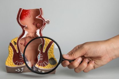 Benessere vascolare: perché sostenere il microcircolo aiuta a ridurre i fastidi legati alle emorroidi Benessere vascolare: perché sostenere il microcircolo aiuta a ridurre i fastidi legati alle emorroidi