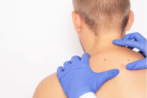 Emorroidi e Fibroma Pendulo: differenze e come riconoscerle