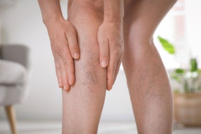 Migliorare il Microcircolo con gli Integratori per il Benessere delle Tue Gambe